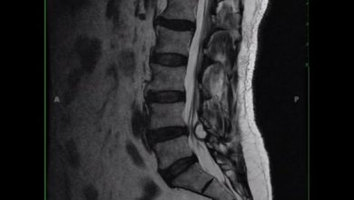 Spinal Cysts