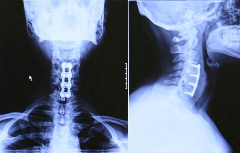 after Spinal Fusion for Cervical Spinal Stenosis