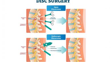 open discectomy and endoscopic discectomy