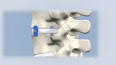 VerteLoc System for Spinal Stenosis Surgery
