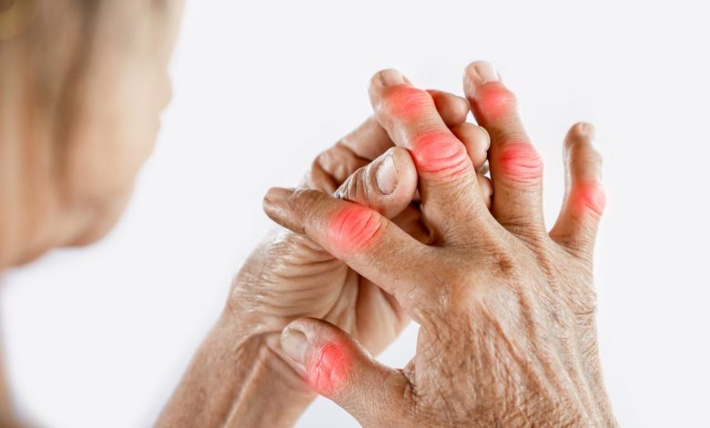 Old woman hand suffering from joint pain with finger gout